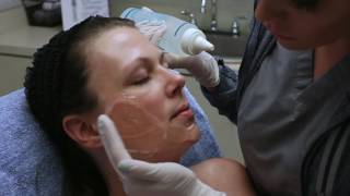 How does the IPL Photofacial work Watch and learn  Seiler Skin [upl. by Lion819]