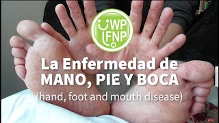 La enfermedad de mano pie y boca hand foot and mouth disease [upl. by Elehcar]