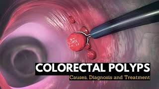 Colorectal Polyps Causes Signs and Symptoms Diagnosis and Treatment [upl. by Older233]