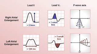 Intro to EKG Interpretation  Chamber Enlargement [upl. by Norred]