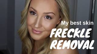 FRECKLE Pigmentation REMOVAL  My Clearest Skin Ever [upl. by Waylon]