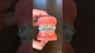 How to Wear Your Orthodontic Elastics  Dr Bar The Braces Doc [upl. by Madid]