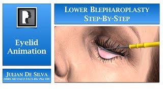 Blepharoplasty Animation – How is Lower Blepharoplasty Eyelid Surgery completed [upl. by Lu88]