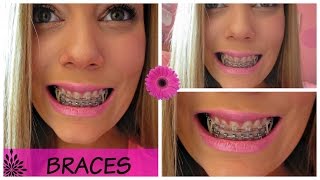 Adult Braces Elastics Powerchain Brackets [upl. by Eenar]