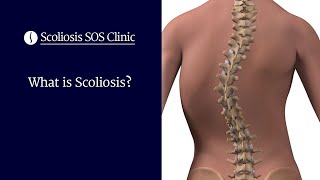 Scoliosis Treatment for Children [upl. by Furlong]