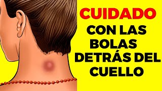 BOLA DETRÁS DEL CUELLO ¿Por qué sale y cuando ir al doctor [upl. by Auqinehs]