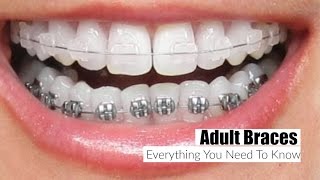 Adult Braces Everything You Need To Know MissLizHeart [upl. by Kcirddot239]