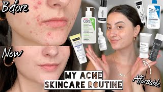 How I Cleared My HORMONAL ACNE amp SCARRING with Affordable Skincare  Dry amp Sensitive Skin [upl. by Eelimaj]