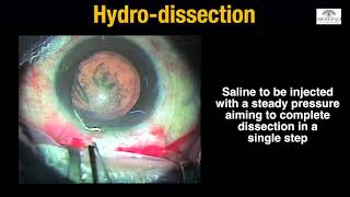 Episode 3  Hydroprocedures in MSICS [upl. by Alda872]