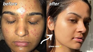 how i cleared my acne FOR GOOD something finally worked [upl. by Rafa385]