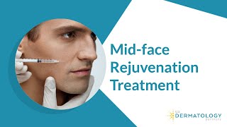 Midface Dermal Filler Treatment [upl. by Lubin]