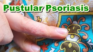 Pompholyx of Pustular Psoriasis  Topical Corticosteroids amp Antibiotics  Betamethasone  Gentamicin [upl. by Artinak]