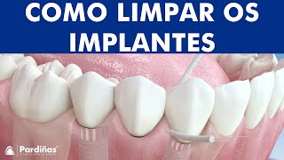 Fio dental e Irrigador  Limpeza de implantes dentários © [upl. by Araeic]