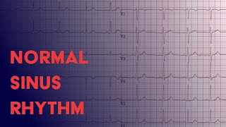 Normal Sinus Rhythm  EKG ECG Interpretation [upl. by Neehcas]