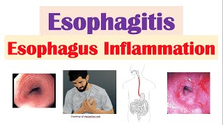 Esophagitis Esophagus Inflammation Causes Risk Factors Signs and Symptoms Diagnosis Treatment [upl. by Esertal650]