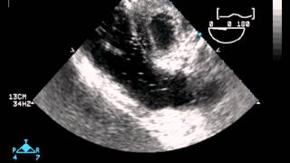 Transesophageal Echocardiography [upl. by Pike207]