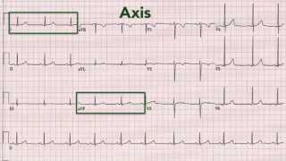 ECG interpretation recognising normal [upl. by Alak]