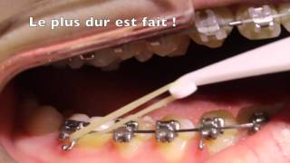 Mettre ses élastiques intermaxillaires en orthodontie [upl. by Alvira873]