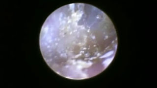 Dust Mites In Human Ears Feed On Skin [upl. by Dale]