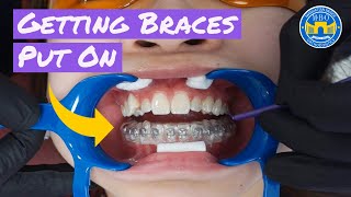 Process of Getting Braces [upl. by Greenland737]