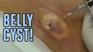 The Tummy Cyst  Busted [upl. by Sucramaj]