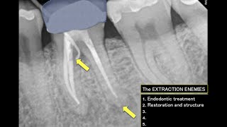 How to extract a lower molar PART 2 [upl. by Sokul]