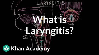 How to manage of Laryngitis  Dr Sriram Nathan [upl. by Sanjiv]