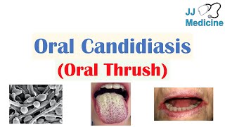 Oral Candidiasis Oral Thrush  Causes Pathophysiology Signs amp Symptoms Diagnosis Treatment [upl. by Dranoel]