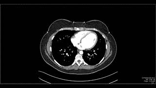 Abdominal Anatomy on Computed Tomography [upl. by Sylvester869]