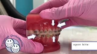 Elastics in Orthodontics  Class 2 Triangle Elastics [upl. by Retla]