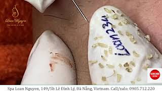 Blackheads extraction 234  Loan Nguyen [upl. by Dita]