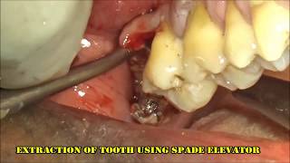 Severely infected upper right 3rd molar extraction [upl. by Madea]