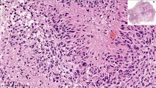 Glioblastoma  Histopathology [upl. by Sylado864]