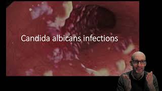 Candida albicans infections [upl. by Dibbrun80]