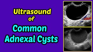 Ultrasound Pearls Epidermal inclusion cyst [upl. by Daugherty838]