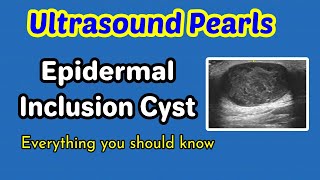 Epididymal cysts excision patient information [upl. by Jeffers990]