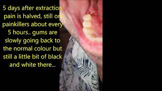 Molar extraction healing process [upl. by Moriah]