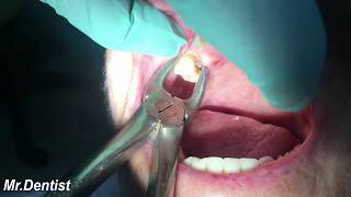 Extraction Of Molar Tooth [upl. by Notecnirp600]