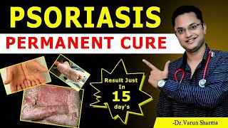 Psoriasis Cure Permanently  Psoriasis Ayurvedic Treatment  Psoriasis ka Ayurvedic ilaj [upl. by Lynsey]