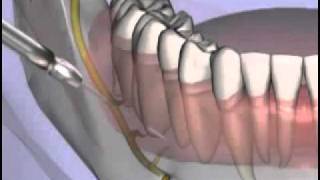 Malameds Local Anesthesia 11 Supplemental Injection Techniques [upl. by Blas]