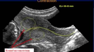 Sonography of the Cervix [upl. by Isaak547]